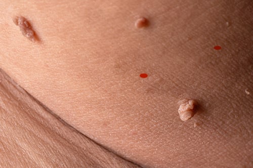 Skintag Picture