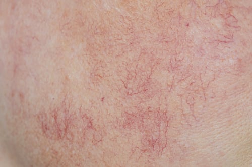 Skintag Picture